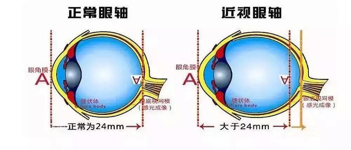 验光师培训，正真视光